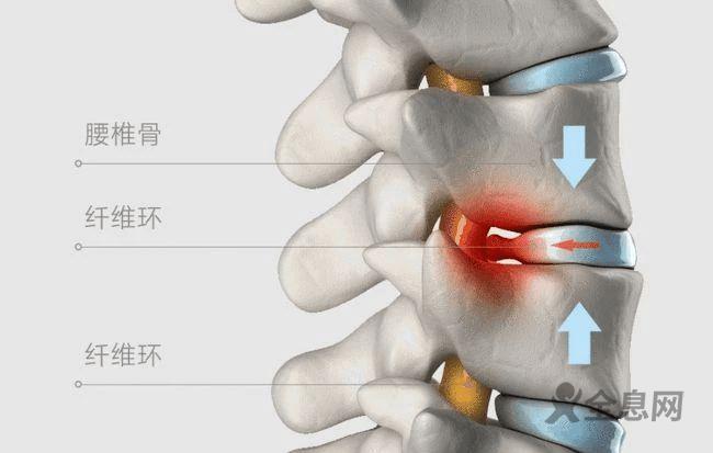 为什么会患上腰椎间盘突出