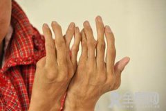 类风湿关节炎为何“重女轻男”？受雌激素水平影响