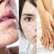 干燥综合症的预防